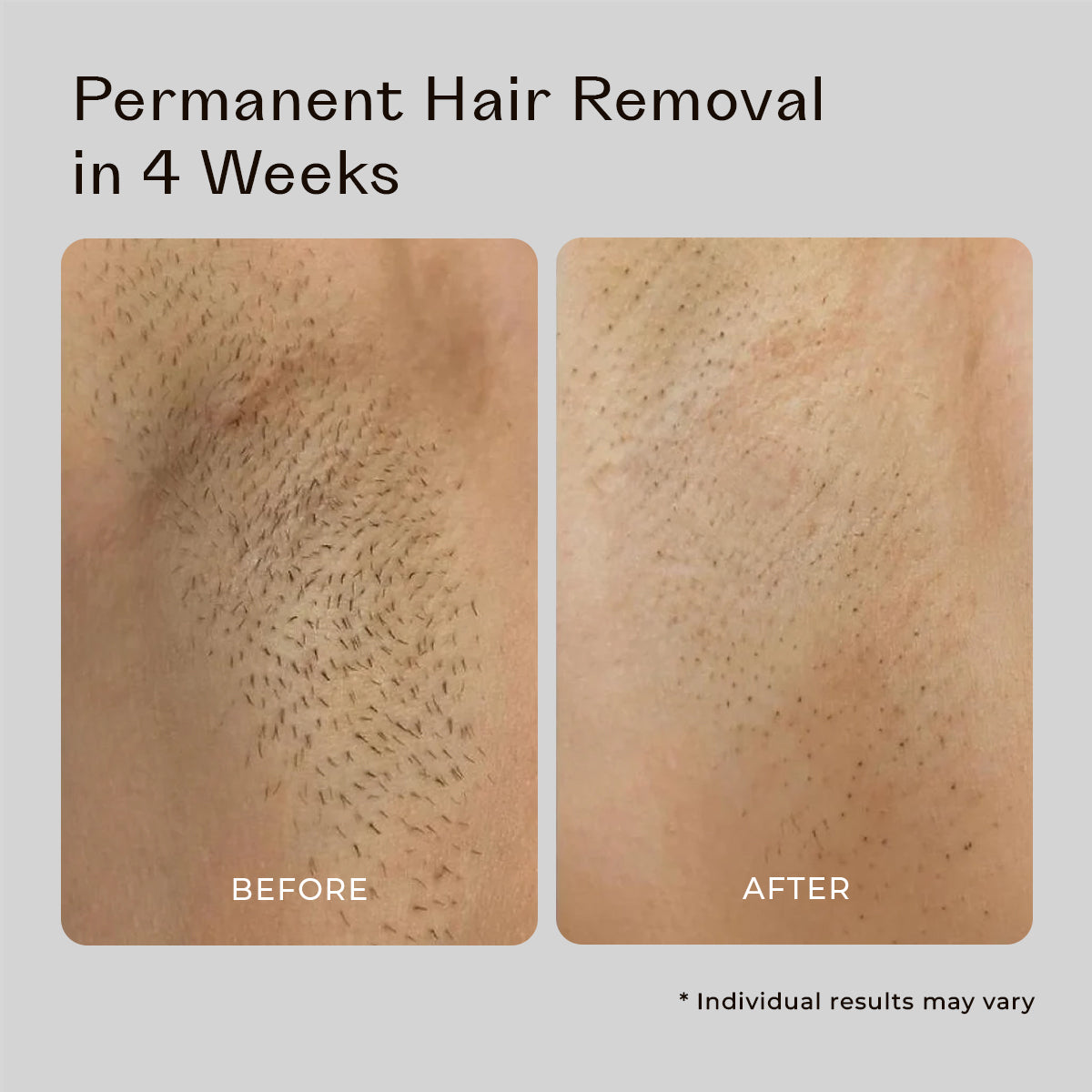 5MINSKIN AT-HOME LASER HAIR REMOVAL HANDSET - 50% OFF HALLOWEEN SALE