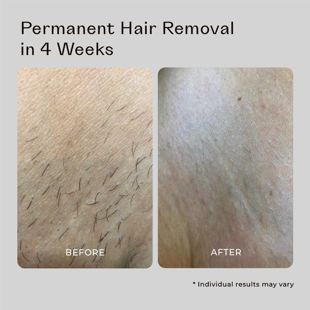 5MINSKIN AT-HOME LASER HAIR REMOVAL HANDSET - 50% OFF HALLOWEEN SALE