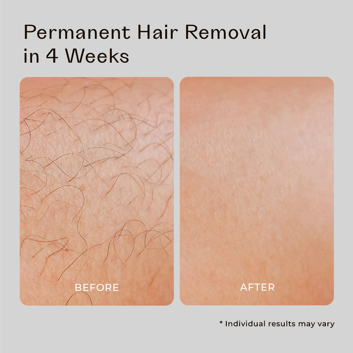 5MINSKIN AT-HOME LASER HAIR REMOVAL HANDSET - 50% OFF HALLOWEEN SALE
